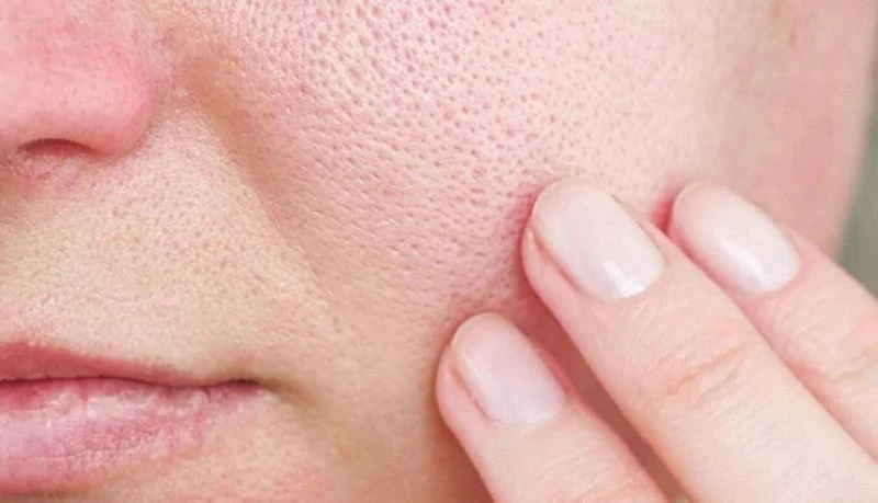 Top 5 kem trị mụn ẩn hiệu quả nhất được bác sĩ khuyên dùng 21 Lỗ chân lông to trên mặt