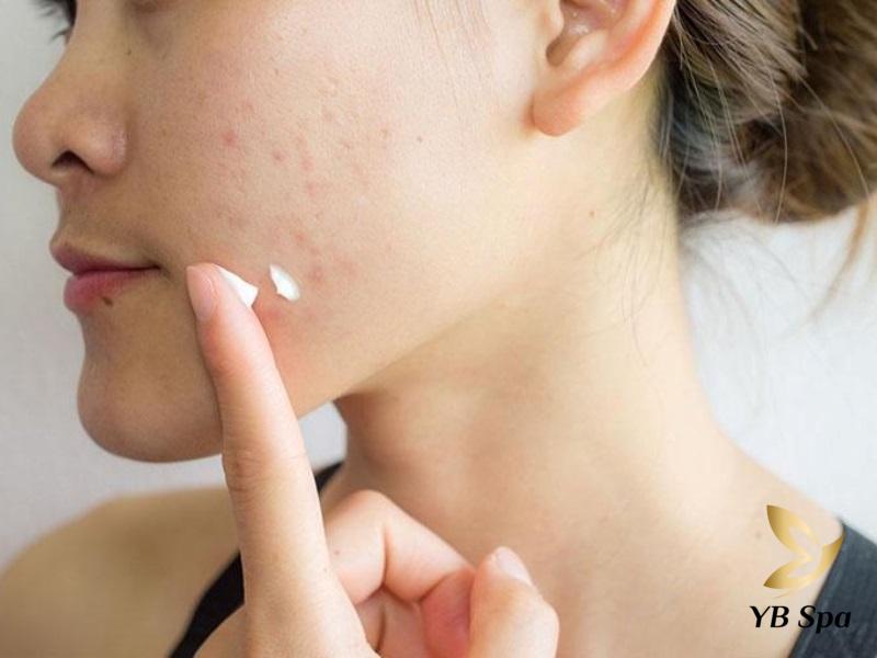 kem trị mụn viêm