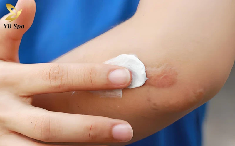 Top 5 kem trị sẹo da liễu phù hợp với từng loại da 25 Kem trị sẹo da liễu là gì?