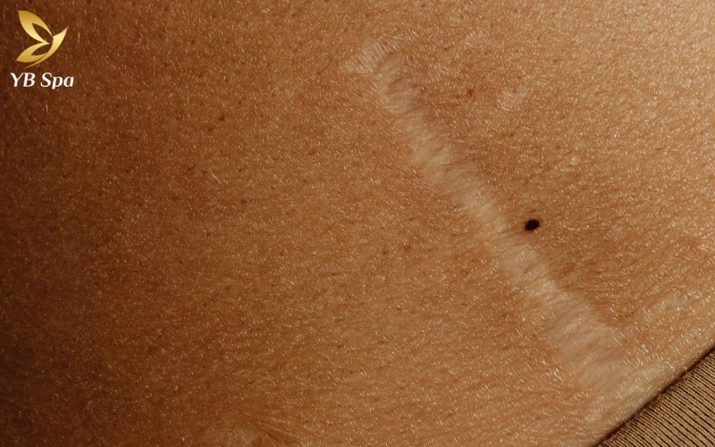 Top 5 kem trị sẹo da liễu phù hợp với từng loại da 33 Sẹo lõm (sẹo rỗ)