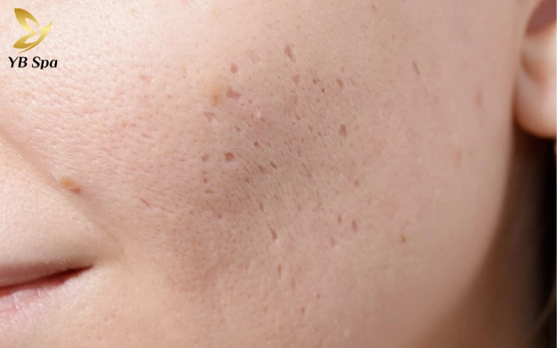 Top 5 kem trị sẹo da liễu phù hợp với từng loại da 34 Sẹo thâm và sắc tố sau viêm