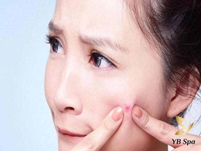 Không nặn mụn có tự hết không? Cách nặn và điều trị mụn chuẩn 25 việc xử lý mụn không đúng cách sẽ gây ra rất nhiều ảnh hưởng tiêu cực