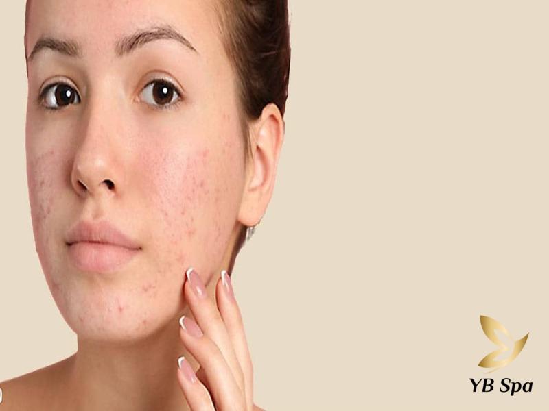 Không nặn mụn có tự hết không? Cách nặn và điều trị mụn chuẩn 26  một số loại mụn có nhân thì nếu không loại bỏ đúng cách sẽ gây viêm da