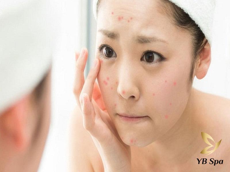 Không nặn mụn có tự hết không? Cách nặn và điều trị mụn chuẩn 27  tình trạng da bị mụn nhẹ, có thể điều trị tại nhà