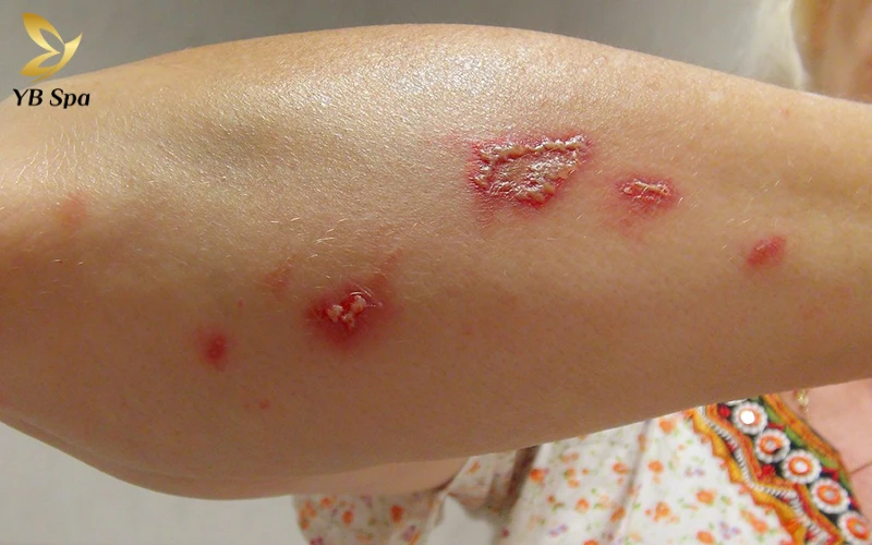 Kiến ba khoang cắn có để lại sẹo không 2