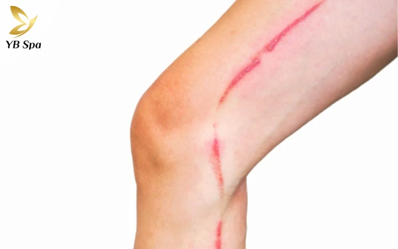 nhận biết vết cắn của kiến ba khoang