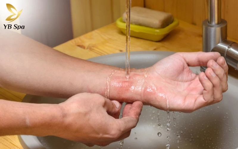 Hướng dẫn xử lý khẩn cấp khi bị kiến ba khoang cắn