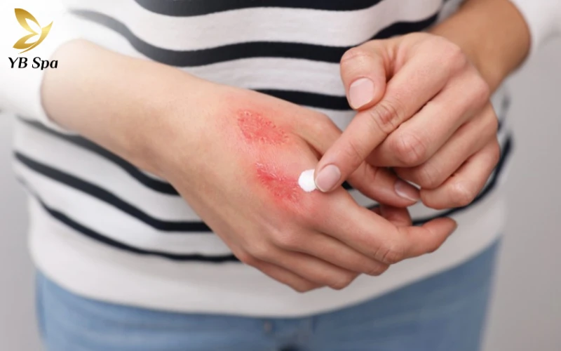 Thuốc bôi Kháng viêm (Corticosteroid)