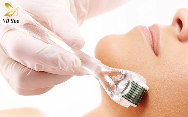 Chia sẻ kinh nghiệm lăn kim trị sẹo rỗ từ khách hàng và chuyên gia 19 kinh nghiệm lăn kim trị sẹo rỗ