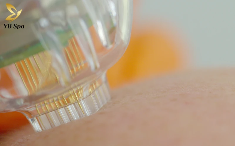 Chia sẻ kinh nghiệm lăn kim trị sẹo rỗ từ khách hàng và chuyên gia 21 Hiệu quả lăn kim đối với từng loại sẹo rỗ