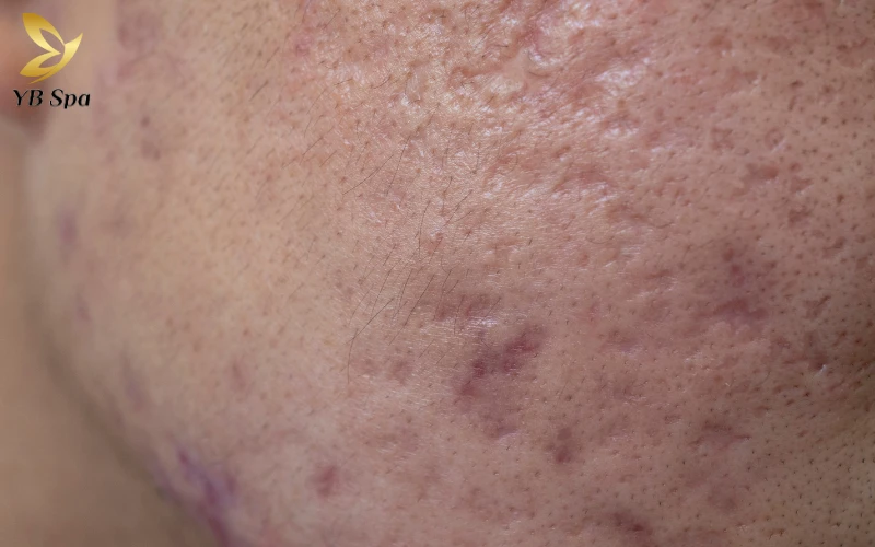 Kinh nghiệm trị sẹo rỗ an toàn, hiệu quả từ chuyên gia 25 Kinh nghiệm trị sẹo rỗ an toàn