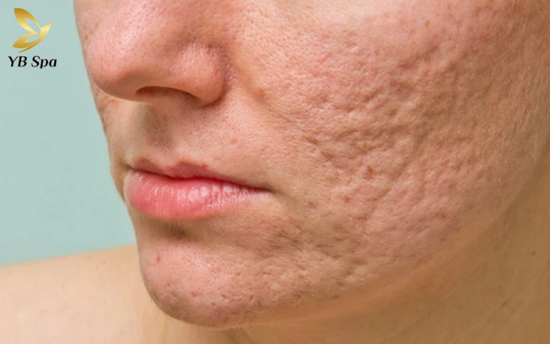 Kinh nghiệm trị sẹo rỗ an toàn, hiệu quả từ chuyên gia 26 Sẹo rỗ là gì?