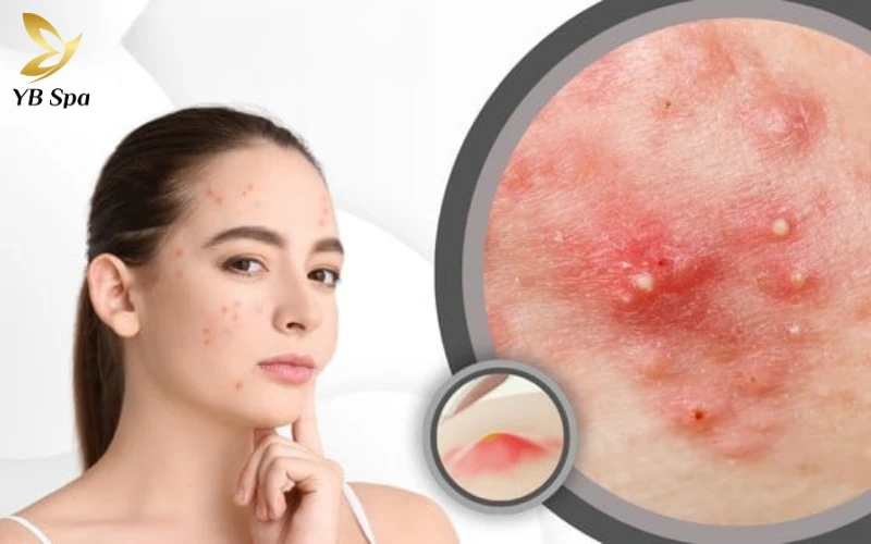 Kinh nghiệm trị sẹo rỗ an toàn, hiệu quả từ chuyên gia 27 Những nguyên nhân hình thành sẹo rỗ