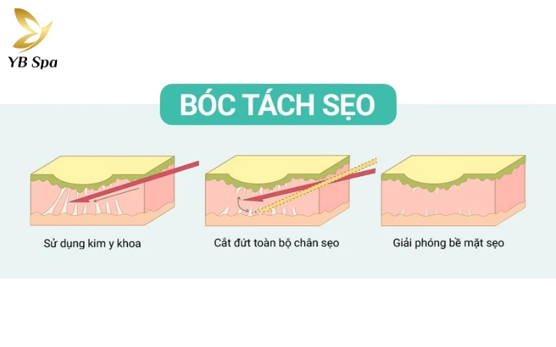 Kinh nghiệm trị sẹo rỗ an toàn, hiệu quả từ chuyên gia 30 Cắt đáy sẹo (Subcision)