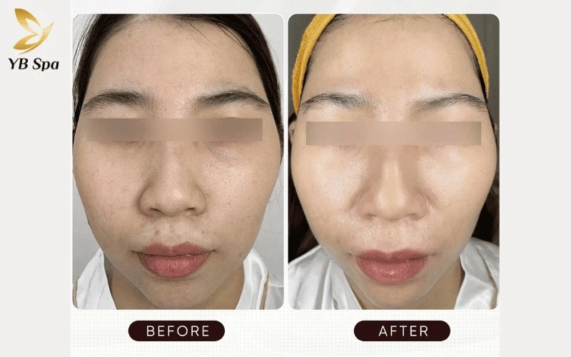 Thực hiện LinearZ sớm ở giai đoạn 22-28 tuổi giúp củng cố nền tảng da và ngăn chặn hiệu quả sự suy giảm collagen do áp lực cuộc sống.