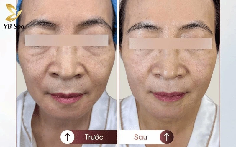 LinearZ hỗ trợ phục hồi cấu trúc nền cho làn da trên 45 tuổi bị ảnh hưởng nghiêm trọng bởi quá trình lão hóa tự nhiên và ánh nắng mặt trời