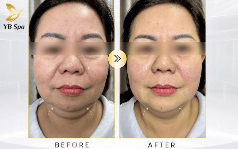 Chế độ Linear Mode giúp LinearZ dẫn đầu trong việc giảm mỡ nọng cằm nhờ khả năng phân bổ nhiệt diện rộng và tác động trúng đích tế bào mỡ