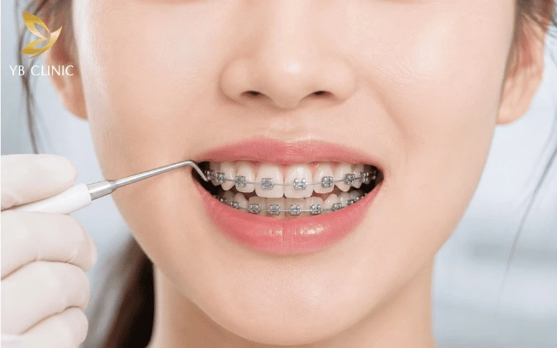 Niềng răng giúp điều chỉnh khớp cắn và cải thiện sự cân đối của nửa dưới gương mặt theo thời gian.