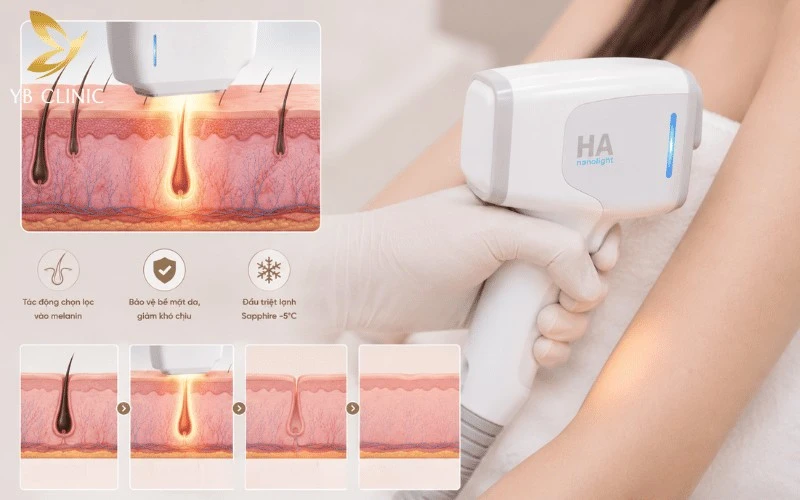Làm Sao Để Hết Lông Gáy? Các Phương Pháp Và Lưu Ý An Toàn 7 Nano Diamond Light sử dụng ánh sáng thông minh tác động chọn lọc vào melanin trong nang lông, hỗ trợ làm suy yếu gốc lông và mang lại hiệu quả triệt lông gáy tối ưu.