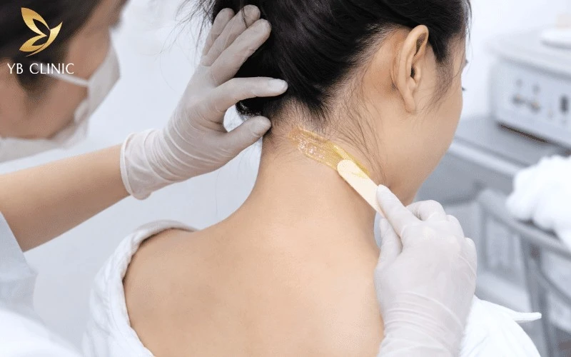 Làm Sao Để Hết Lông Gáy? Các Phương Pháp Và Lưu Ý An Toàn 8 Waxing là phương pháp loại bỏ lông bằng sáp nóng hoặc sáp lạnh, giúp lấy đi sợi lông từ bề mặt đến phần gốc, mang lại làn da láng mịn trong thời gian ngắn.