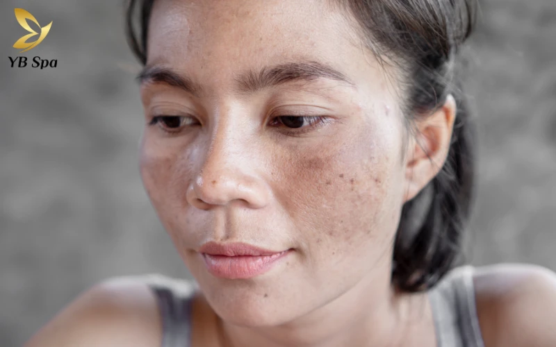 Làm sao để nám không tái phát