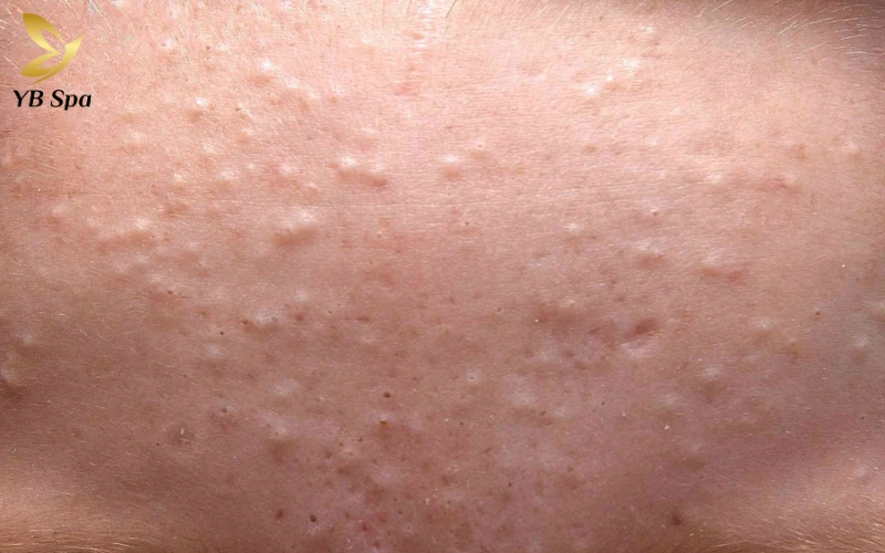 Làm sao để hết mụn ẩn?