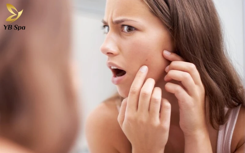 không tự ý nặn mụn