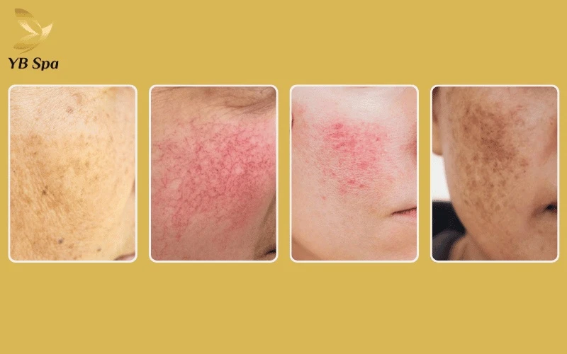 Được coi là "tiêu chuẩn vàng", Laser Chrome giải quyết đồng thời nhiều khuyết điểm da liễu phức tạp chỉ trong một liệu trình chuyên sâu