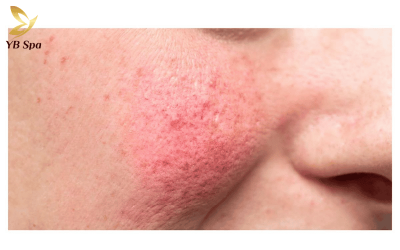 Laser trị thâm mụn có tốt không? Hoạt động như thế nào? 12 Thâm đỏ PIE thực chất là sự giãn nở của các mạch máu dưới da sau viêm chứ không phải do sắc tố melanin gây ra