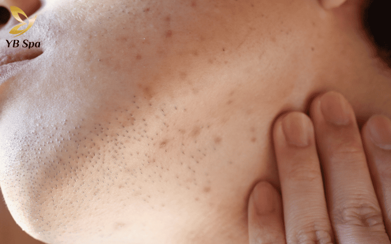 Laser trị thâm mụn có tốt không? Hoạt động như thế nào? 13 Thâm đen (PIH) hình thành từ sự dư thừa sắc tố, đòi hỏi các phương pháp tác động sâu để phá vỡ cấu trúc melanin bền vững.