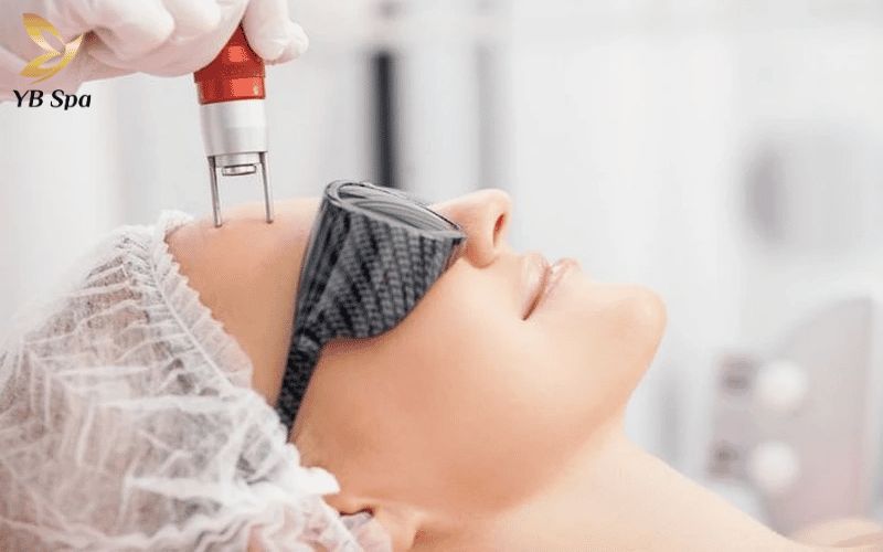 Laser trị thâm mụn có tốt không? Hoạt động như thế nào? 15 Laser Nd:YAG là "khắc tinh" của các vết thâm đen lâu năm, nám và tàn nhang nhờ khả năng phá hủy melanin mạnh mẽ.