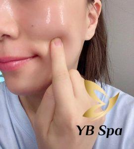 Tiêm Meso Trị Nám Có Tốt Không?