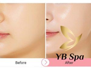 Trị liệu Mesotherapy trẻ hóa có “thần kỳ” như lời đồn? 