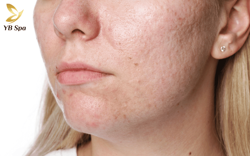 Liệu trình tiêm meso trị sẹo rỗ chuẩn y khoa giúp kích hoạt mạnh mẽ collagen tự thân mang đến diện mạo mịn màng, không tì vết cho làn da