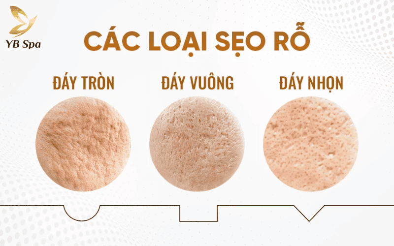 Liệu trình Meso được thiết kế riêng biệt để mang lại hiệu quả tối ưu cho từng loại sẹo lượn sóng, hình hộp hay đáy nhọn