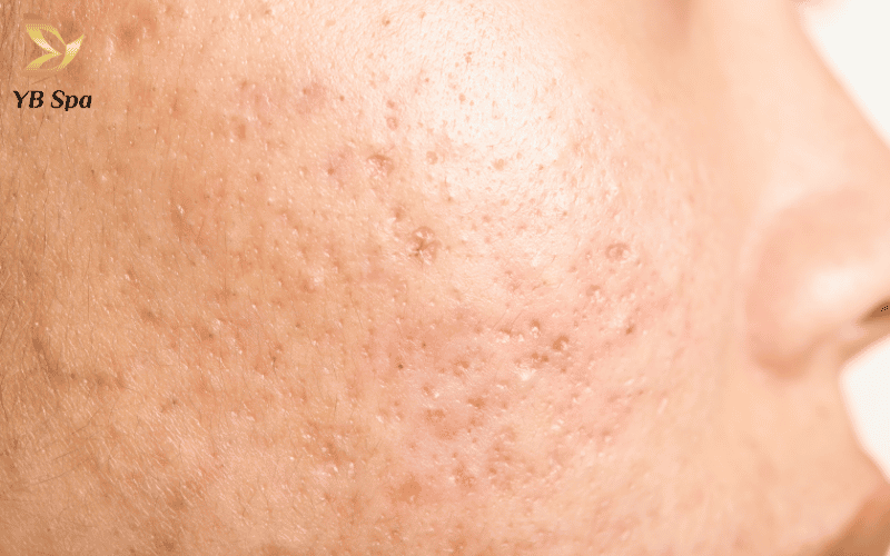 Tuổi thọ vết sẹo càng ngắn, khả năng hấp thụ dưỡng chất của da càng cao, giúp san phẳng vết lõm nhanh chóng