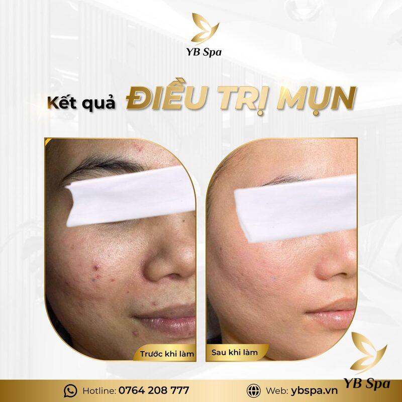 Đánh bay mụn, Sáng mịn da chỉ với Liệu trình trị mụn Carboxy 25 Liệu trình trị mụn Carboxy giúp làn da thêm hoàn hảo và rạng ngời (Nguồn: YB Spa)