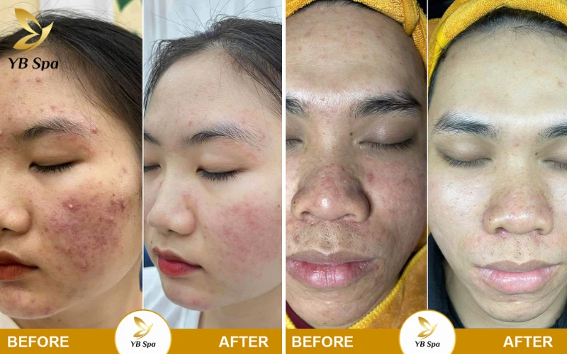 Vì sao chọn YB Spa để điều trị mụn?