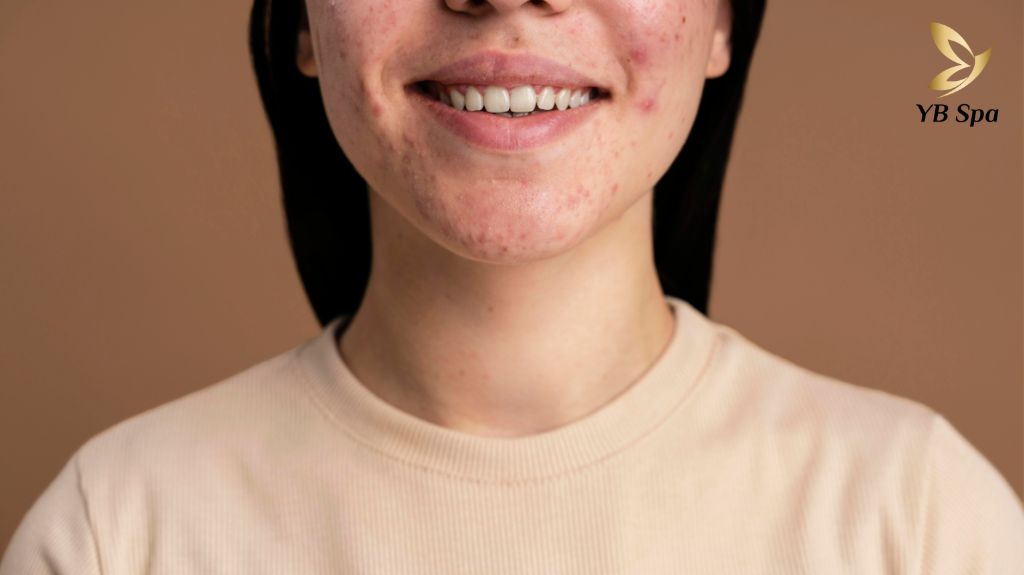 Liệu trình trị mụn Carboxy chuẩn Y Khoa 21 Lieu Trinh Tri Mun Carboxy 3