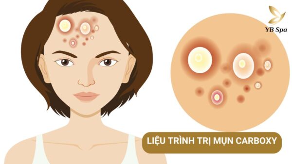 Liệu Trình Trị Mụn Carboxy