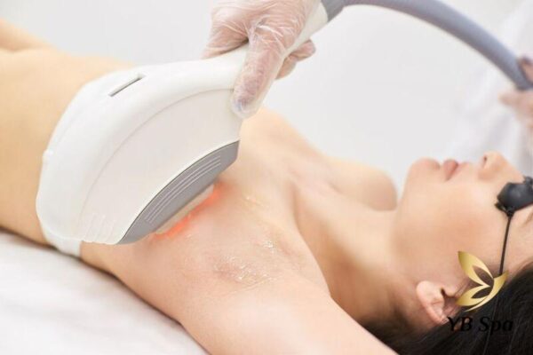 Liệu trình triệt lông bao nhiêu buổi là hiệu quả? (Nguồn: YB Spa)