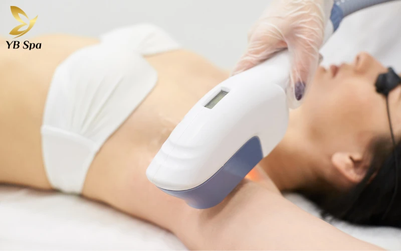 Dù diện tích nhỏ nhưng vùng nách cần công nghệ hiện đại để xử lý triệt để các nang lông sâu và cứng