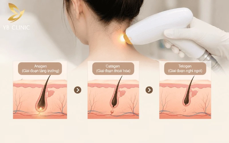 Liệu Trình Triệt Lông Gáy Gồm Bao Nhiêu Buổi Và Giá Bao Nhiêu 8 Chu kỳ sinh trưởng của sợi lông quyết định hiệu quả triệt lông bằng công nghệ ánh sáng, trong đó giai đoạn Anagen là thời điểm lý tưởng để tác động vào nang lông.