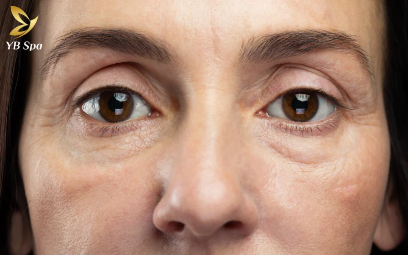 LinearZ là gì? Tìm hiểu công nghệ nâng cơ HIFU thế hệ mới 2026 26 Điều trị lão hóa sớm với LinearZ chính là cách đầu tư hiệu quả nhất để giữ chân nét thanh xuân và tiết kiệm chi phí làm đẹp về lâu dài