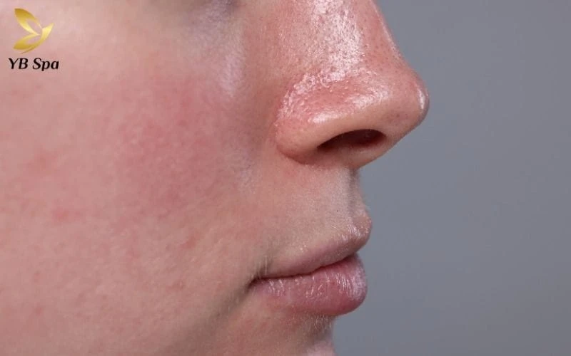 Hiện tượng đỏ da và sưng nhẹ là phản ứng tích cực cho thấy công nghệ LinearZ đang kích thích tăng sinh collagen hiệu quả dưới da