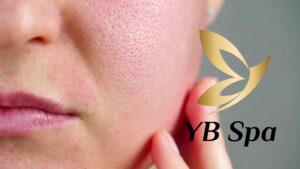 Lỗ chân lông to trên mặt có thể nhìn bằng mắt thường (Nguồn: Internet) 