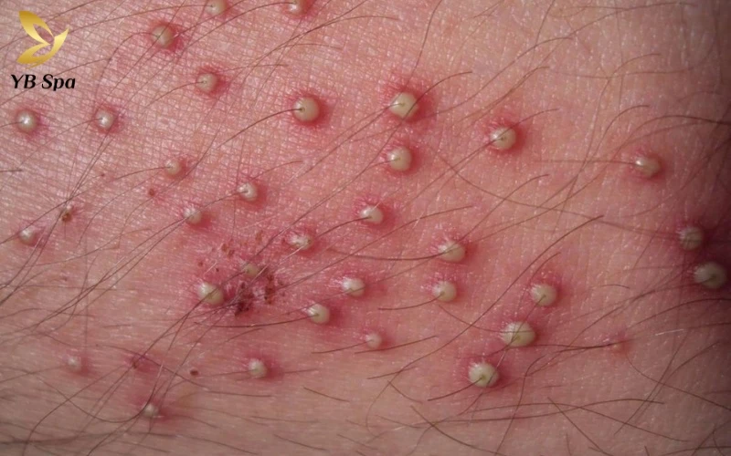 Hiện tượng lông rụng đi kèm với nốt đỏ và mụn mủ là "tín hiệu" rõ rệt của tình trạng viêm nang lông (folliculitis) cần được xử lý kịp thời