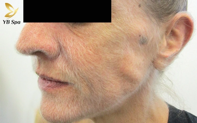 Hypertrichosis lan tỏa không chỉ ảnh hưởng đến thẩm mỹ mà còn là biểu hiện của sự phát triển nang lông bất thường trên khắp cơ thể và vành tai