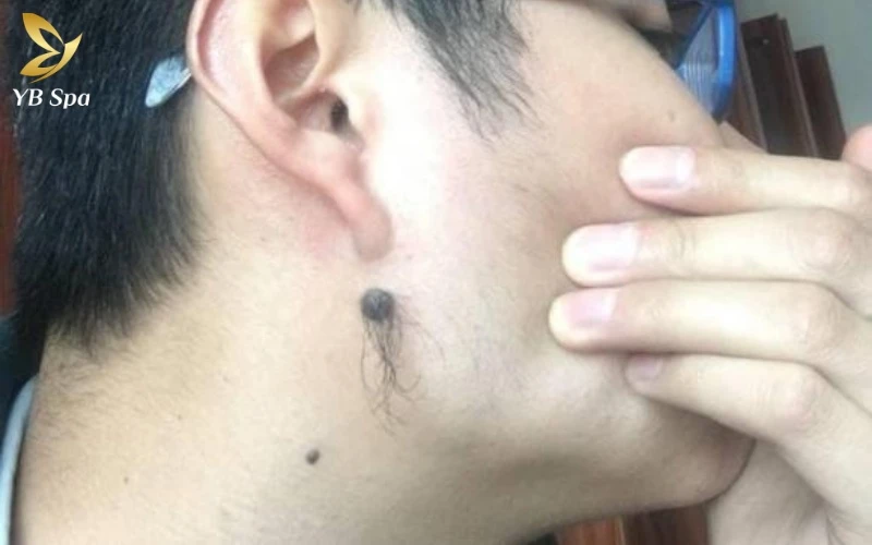 Lông tài là gì? Giải mã từ góc nhìn khoa học và nhân tướng (2026) 22 Sự kết hợp giữa sắc tố da và nguồn dưỡng chất mạnh mẽ tạo nên những sợi lông tài trên nốt ruồi – dấu hiệu của sự thịnh vượng