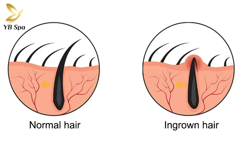 Tướng phụ nữ nhiều lông tay nói lên điều gì? 14 Lông mọc ngược (Ingrown hair) thường là hệ quả tất yếu của việc xử lý lông tay bằng các phương pháp thủ công thiếu khoa học